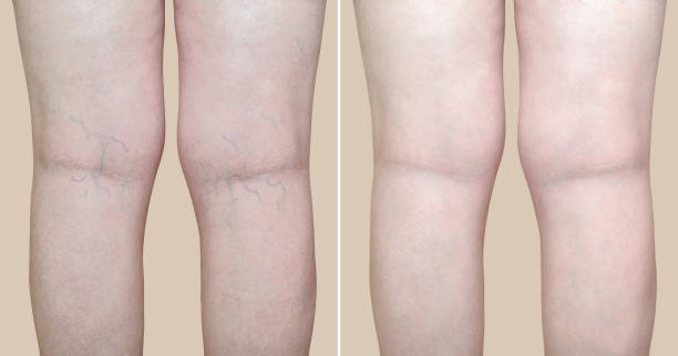 ClariVein: A Revolutionary Treatment for Varicose Veins